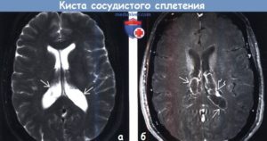 Двусторонние кисты хороидных сплетений боковых желудочков мозга