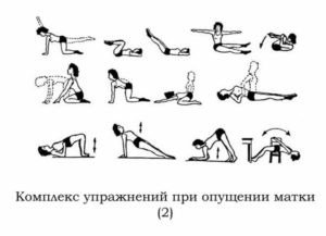 Возможно ли опущение матки при кручении обруча?