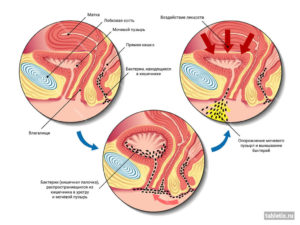 Влияние кишечной палочки на мочевой пузырь