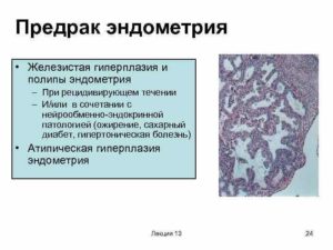 Внутренний эндометриоз и железистая гиперплазия эндометрия