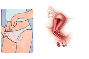 Длительные месячные, кровь после клиторального оргазма