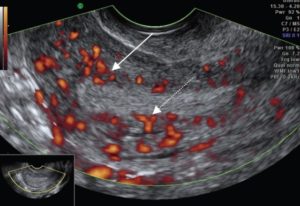 Доплер сосудов матки