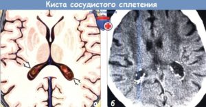 Двусторонние кисты хороидных сплетений боковых желудочков мозга