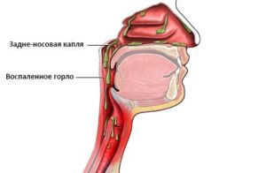 Выделения скапливаються и стекают по задней стенки глотки