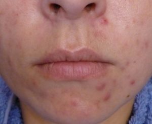 Возможна ли сильная сыпь на лице при приеме еутирокса?