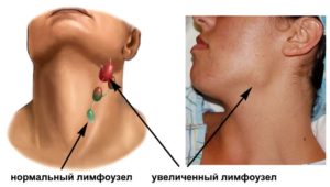 Воспаление лимфоузла на шее и зубы