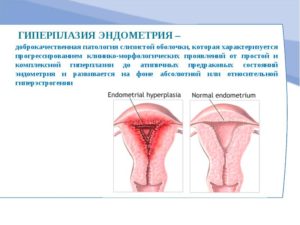 Чем вылечить гиперплазию эндометрия при многочисленных противопоказаниях