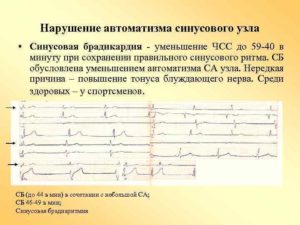 Нарушение сердечного ритма неуточненное(149,9) Дисфункция синусового узла, синусовая брадиаритмия ва