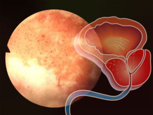 Микоплазма и простатит