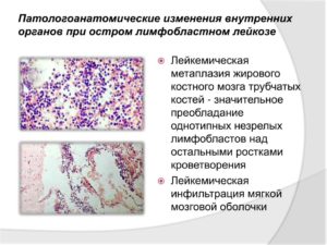 Что такое жировая инфильтрация костного мозга?