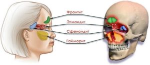 Двусторонний верхнечелюстной синусит, этмоидит, сфеноидит