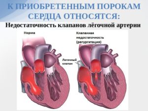 Дисфункция клапана лёгочной артерии
