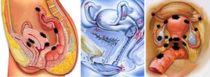 Эндометриоз и зачатие