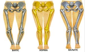 Варус или вальгус?