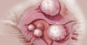 Миома матки интрамуральная, фоликулярная киста левого яичника