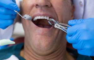 Возможные осложнения после лечения зубов