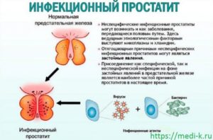 Микоплазма и простатит