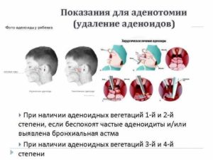 Вегетация аденоидов 2 степени и протаргол