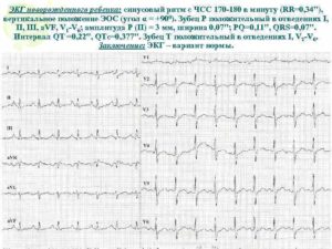 ЭКГ описание, синусовый ритм, вертикальное положение ЭОС