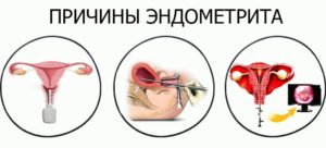 Можно ли заниматься сексом при лечении эндометрита