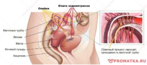 Эндометриоз и спайки