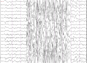 Эпилепсия без изменений на ээг