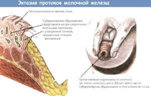 Чем опасно расширение протоков мж