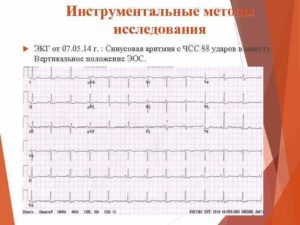 ЭКГ описание, синусовый ритм, вертикальное положение ЭОС