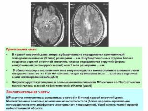 Глиоз в головном мозге на мрт что. Очаг глиоза в правой височной доли головного мозга мрт. Контузионный очаг лобной доли. Контузионные очаги типы. Контузионные очаги в лобных долях.