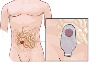 Диарея из толстого кишечника при введении колостомы
