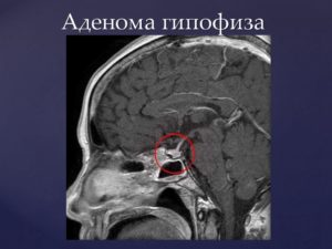 МР картина диффузно неоднородной структуры аденогипофиза