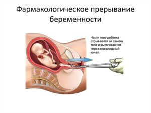 Чистка после фармацевтического аборта