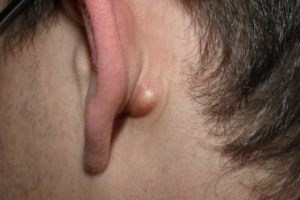 Воспаление мочки уха