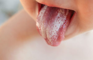 Дисбактериоз налет на языке
