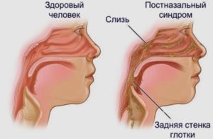 Выделения скапливаються и стекают по задней стенки глотки