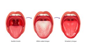 Налет на языке. Белые пятна в горле