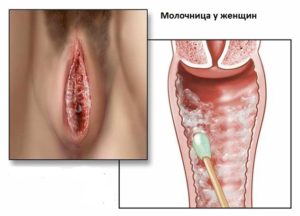 Воспаление малой половой губы