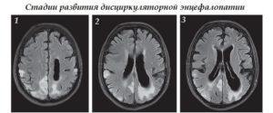 Дисциркуляторная энцефалопатия на МРТ головного мозга