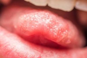 Воспаление на кончике языка
