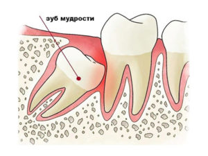 Воспалилась десна после удаления зуба мудрости