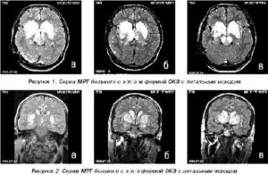 МРТ головного мозга (расшифровка)