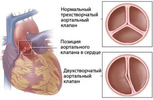 ВПС Двустворчатый аортальный клапан