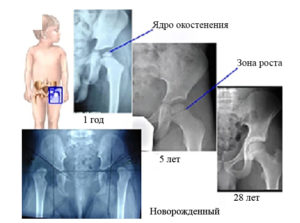 Узи ТБС - отсутствие ядер окостенения