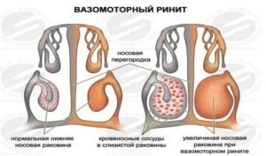 Вазомоторный ринитринит, киста