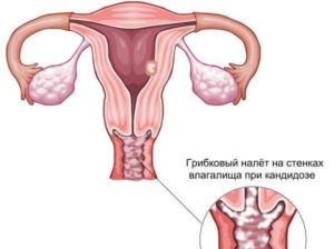 Воспаление яичников, молочница