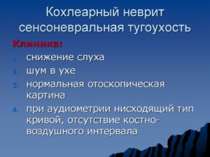 Двусторонняя сенсоневральная тугоухость