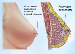 Набухла одна грудь