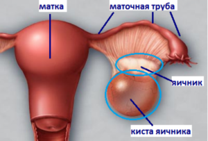 Две кисты на правом яичнике