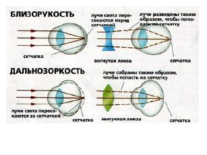 Можно ли при миопии носить линзы