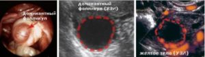 Доминантный фолликул 15 мм